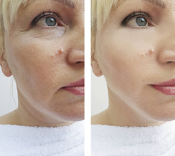 žena vrásky tvář před a po korekci postupy - Fotografie, Obrázek