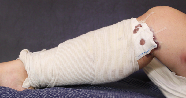 Žena odstraňuje obvazy nohou po operaci křečové žíly - Záběry, video