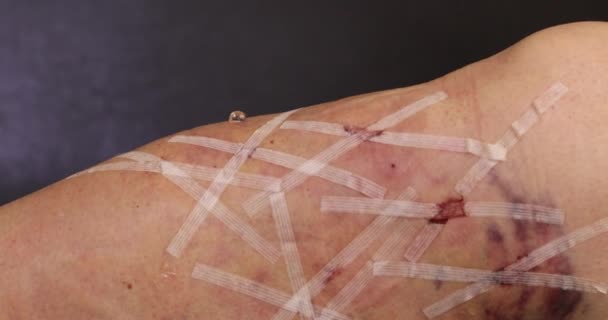 Mujer Quitando vendajes de su pierna después de la operación de la vena varicosa 10
 - Metraje, vídeo