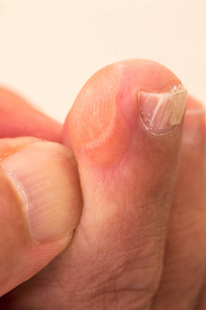 Пальцы ног с большим волдырем сбоку сухая кожа и трещины
 - Фото, изображение