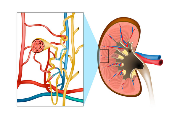 Glomerulonefrite (GN). Inflamação dos glomérulos ou dos pequenos vasos sanguíneos nos rins
. - Vetor, Imagem