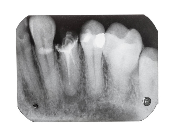 Película con imagen de rayos X de dientes con pasador dental
 - Foto, imagen