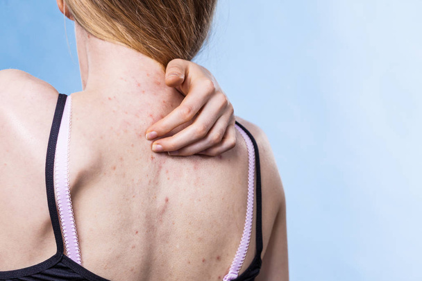 Woman with skin problem acne on back - Fotó, kép