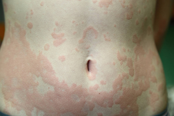 alergiczne zapalenie skóry - Zdjęcie, obraz