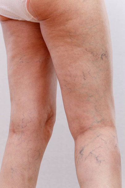 Elderly woman in white panties shows cellulite and varicose veins on a light isolated background. Concept for medicine and cosmetology. - Photo, Image