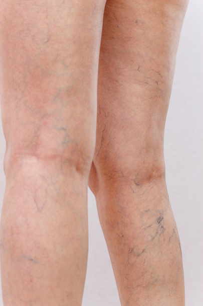 Elderly woman in white panties shows cellulite and varicose veins on a light isolated background. Concept for medicine and cosmetology. - Photo, Image