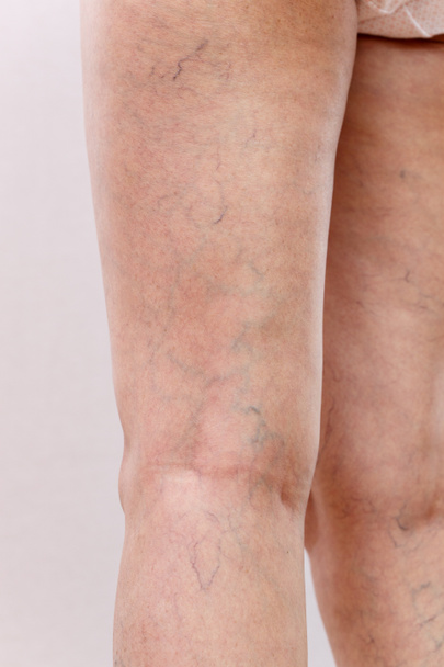 Elderly woman in white panties shows cellulite and varicose veins on a light isolated background. Concept for medicine and cosmetology. - Фото, зображення