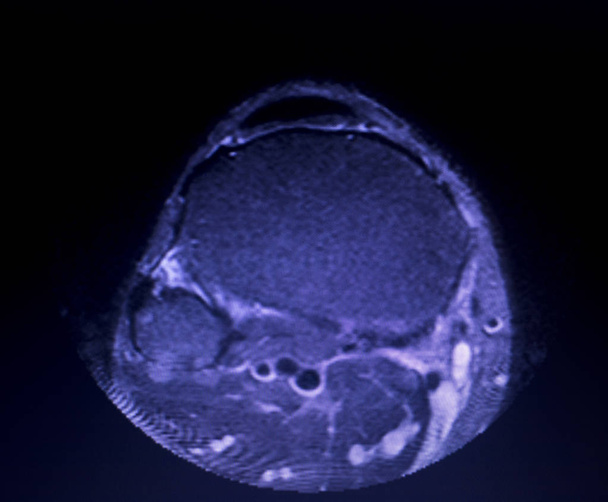 MRI knee meniscus tear scan - Photo, Image