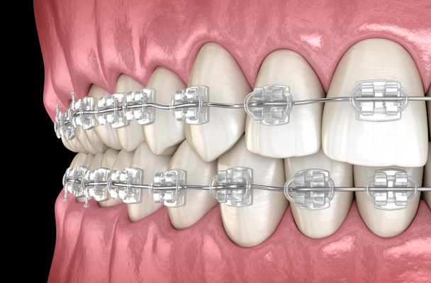 Dents Braces claires dans les gencives. Illustration 3D dentaire médicalement précise
 - Photo, image