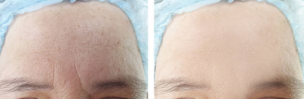 Rugas faciais da mulher idosa antes e depois dos procedimentos
 - Foto, Imagem