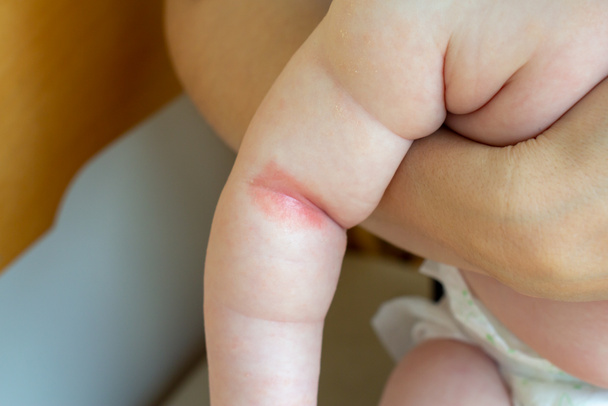Calore pungente. Primo piano delle pieghe della mano di un neonato con pelle rossa
.  - Foto, immagini