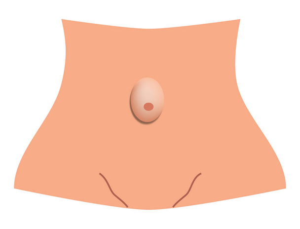 Umbilical hernia. intestinal hernia. Infographics. Vector illustration on isolated background. - Vector, Image