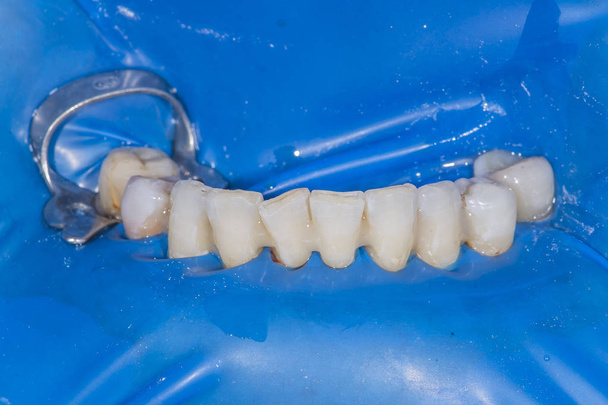 実際の患者歯科手術 - 写真・画像