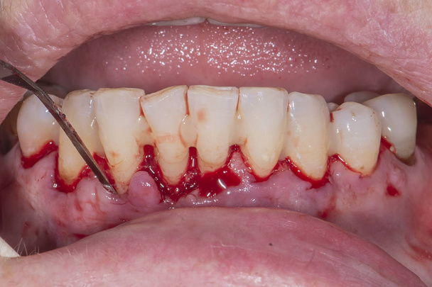 Zubní chirurgie - Fotografie, Obrázek