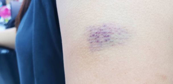Close-up van kneuzing op een gewonde vrouw-arm, huiselijk geweld, kopieer ruimte - Foto, afbeelding
