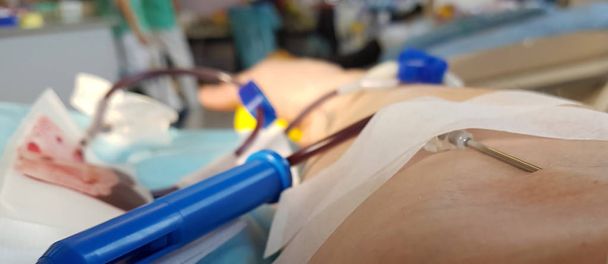 brazo de voluntario durante la donación de sangre en la cama de un médico
 - Foto, imagen