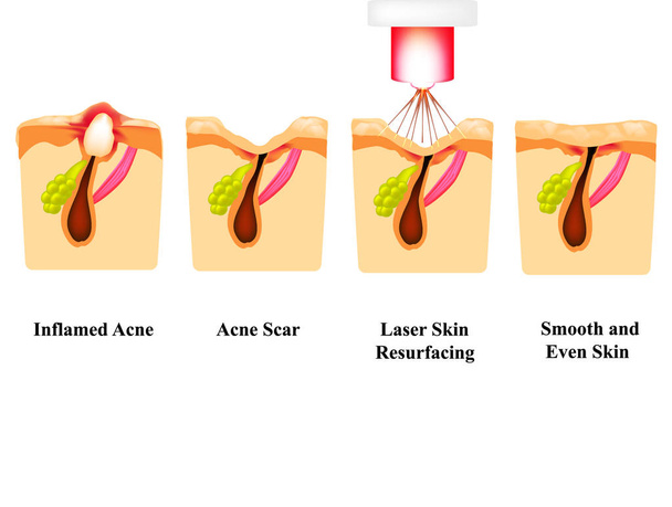 Inflamed acne on the skin. Inflamed pimple. Acne scar. Laser treatment. Laser polishing. The structure of the skin. Wrinkles. Infographics. Vector illustration on isolated background. - Vector, Image