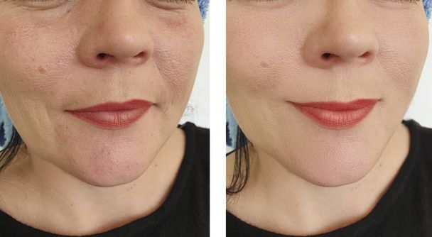жіночі зморшки обличчя до і після корекції
 - Фото, зображення