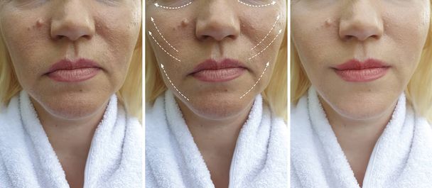 arrugas de la cara de la mujer antes y después de collage corrección
 - Foto, Imagen