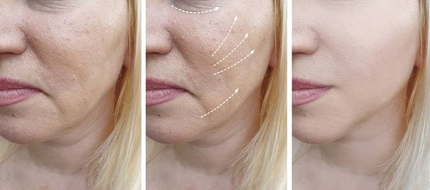 морщины лица женщины до и после коррекции коллажа
 - Фото, изображение