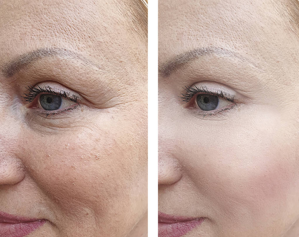 nainen kasvot ryppyjä ennen ja jälkeen hoidon
 - Valokuva, kuva