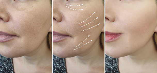 arrugas de la cara de la mujer antes y después de tratamientos
 - Foto, Imagen
