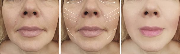 kadın yüz kırışıklıklar öncesi ve tedavi sonrası - Fotoğraf, Görsel