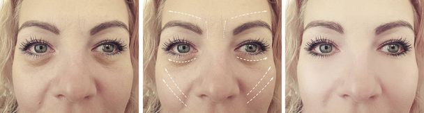arrugas de la cara de la mujer antes y después de tratamientos
 - Foto, Imagen