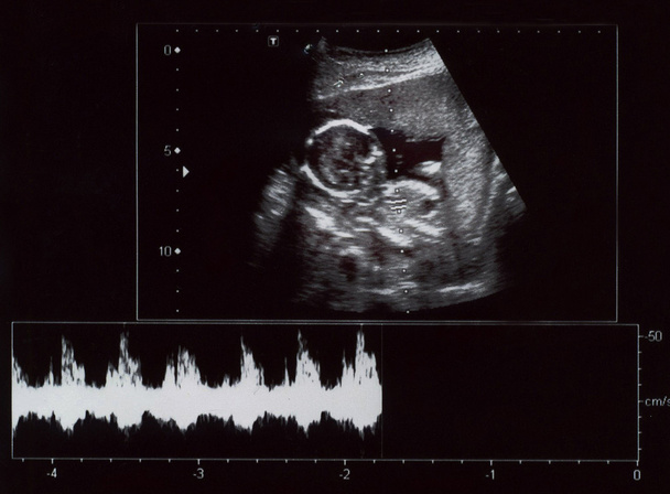 胎児の超音波検査 - 写真・画像