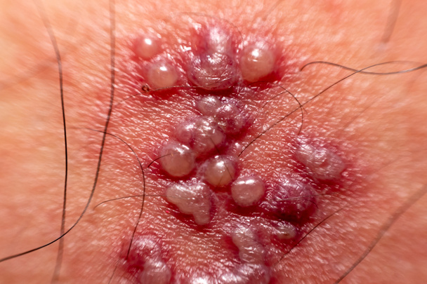 皮膚の発疹や体 (男性帯状疱疹の帯状疱疹の水疱) - 写真・画像