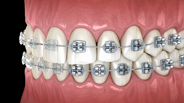 Zuby s kovovým a čirá rovnátka v dámech. Lékařsky přesná zubní 3D animace - Záběry, video