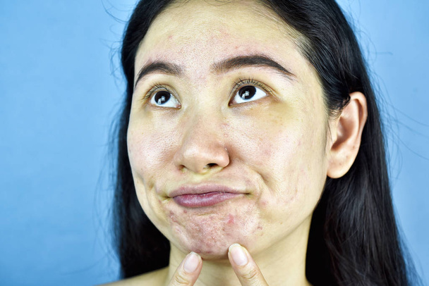 Problema della pelle dell'acne, la donna asiatica infastidisce e annoia per i brufoli ormonali, la mano della ragazza indica il mento, la pelle sensibile e irritata
. - Foto, immagini