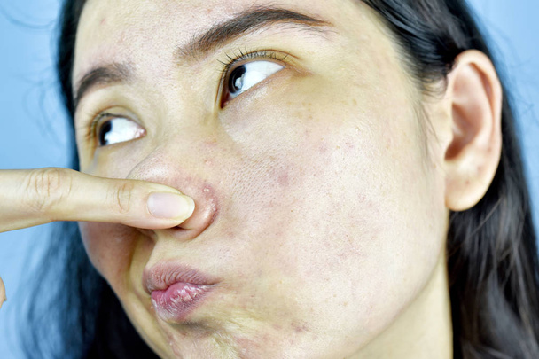 にきび肌の問題、アジアの女性は、ホルモンの吹き出物について迷惑と退屈、彼女の鼻を指す若い女の子の手、敏感で刺激を受けやすい肌. - 写真・画像