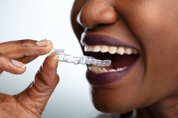 Close-up Of A Woman's Hand Putting Transparent Aligner In Teeth - Φωτογραφία, εικόνα