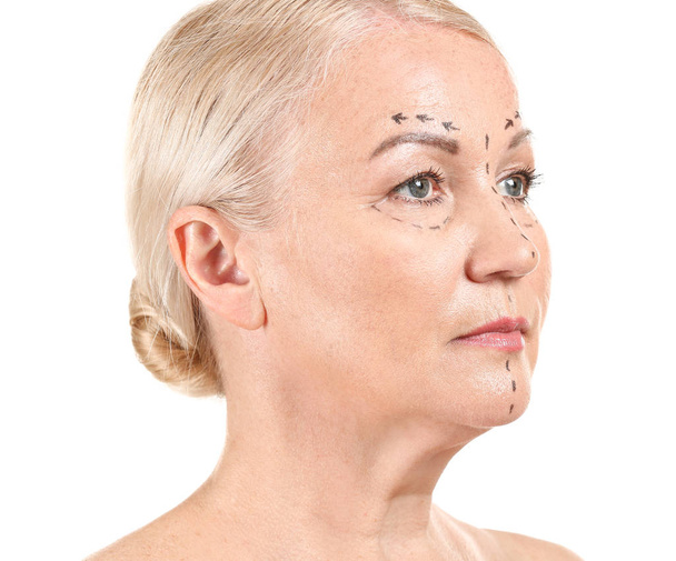 Mujer madura con marcas en la cara sobre fondo blanco. Concepto de cirugía plástica
 - Foto, imagen