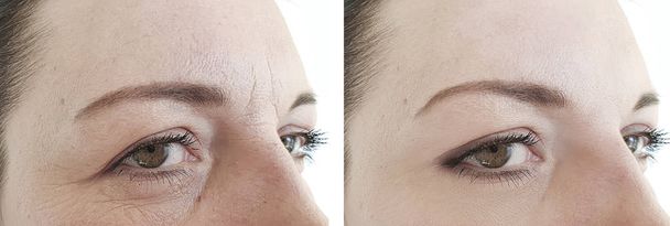 vrouw gezicht rimpels vóór en na de behandelingen - Foto, afbeelding