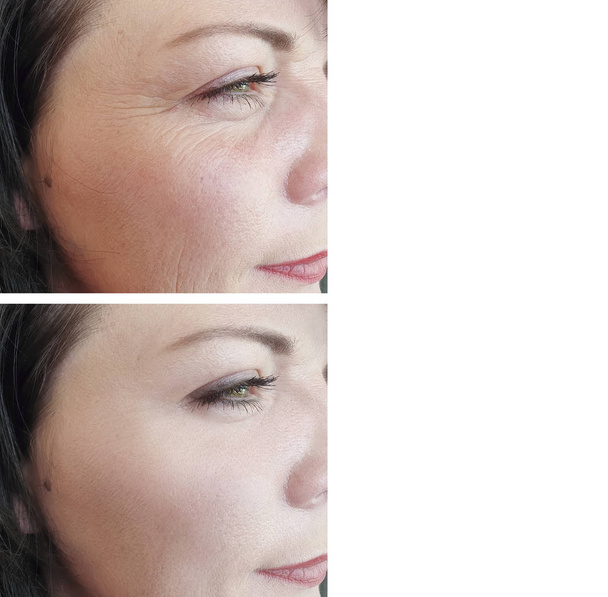 vrouwelijke ogen opgeblazen gevoel voor en na de behandeling - Foto, afbeelding