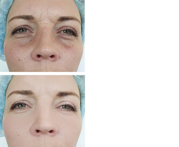 yeux féminins ballonnements avant et après le traitement
 - Photo, image