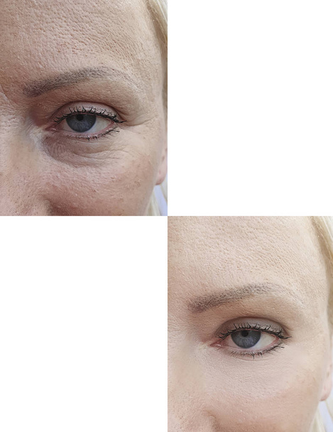 γυναίκα, πρόσωπο ρυτίδες πριν και μετά τη θεραπεία - Φωτογραφία, εικόνα