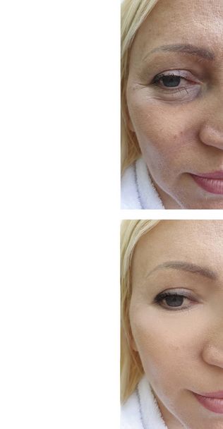 arrugas de la mujer cara antes y después del tratamiento
 - Foto, imagen