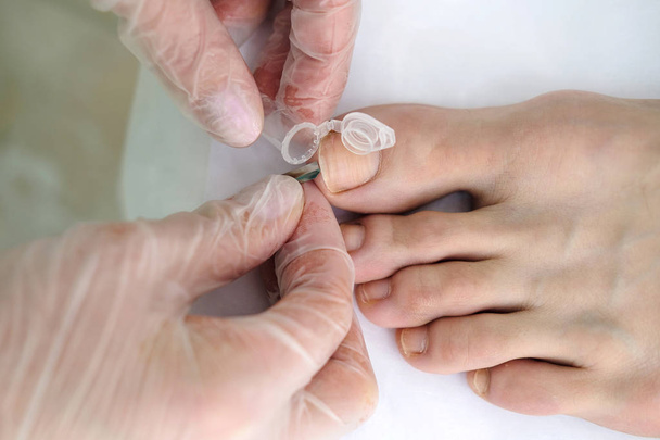皮膚科医は患者の足指の下から分析のためのサンプルを取る。皮膚科 真菌感染症クローズアップ - 写真・画像