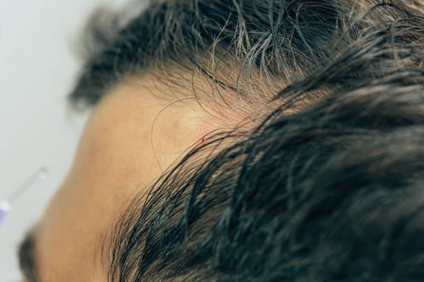 Une tache chauve sur le front d'un jeune homme. La texture des cheveux rares sur la tête d'un homme. Calvitie masculine. Lutter contre la perte de cheveux chez les hommes
. - Photo, image