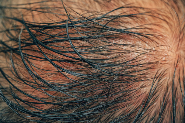 die Beschaffenheit der seltenen Haare auf dem Kopf eines Mannes. Mesotherapie von Haaren und Kopf. Spuren von Injektionen am Kopf nach der Therapie. Männliche Glatzenbildung. Kampf gegen Haarausfall bei Männern. - Foto, Bild