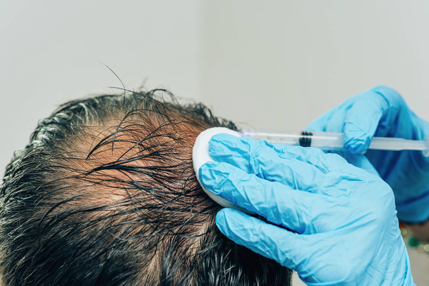 Mesotherapie von Haaren und Kopf. Spritzen in den Kopf. Männliche Glatzenbildung. Bekämpfung des Haarausfalls bei Männern. Glatze des Mannes in der Mitte des Kopfes an der Krone. die Hände des Kosmetikers, der Arzt des Trichologen und der Kopf des Patienten - Foto, Bild
