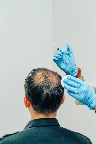 Mesotherapy of hair and head. Injections in the head. Male pattern baldness. Fighting hair loss in men. Men's bald spot in the center of the head at the crown. The hands of the cosmetologist the doctor of the trichologist and the head of the patient - Foto, Imagem