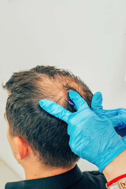 Mesotherapie von Haaren und Kopf. Spritzen in den Kopf. Männliche Glatzenbildung. Bekämpfung des Haarausfalls bei Männern. Glatze des Mannes in der Mitte des Kopfes an der Krone. die Hände des Kosmetikers, der Arzt des Trichologen und der Kopf des Patienten - Foto, Bild