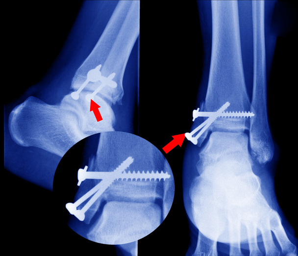 raio-x de fraturas ósseas
 - Foto, Imagem