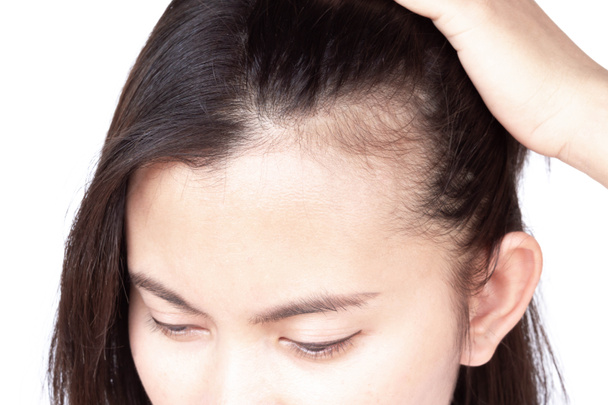 Žena vážný problém vypadávání vlasů pro zdravotní péči šampon a koncepce kosmetických výrobků, selektivní zaměření - Fotografie, Obrázek
