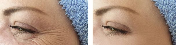Ρυτίδες προσώπου γυναίκα πριν και μετά από διαδικασίες - Φωτογραφία, εικόνα