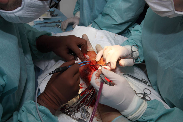Bileği dikmek için ameliyat. Beyin cerrahları ve travmatologlardan oluşan ekip eli onarıyor. Bilekte sinir ve tendon dikmek için ameliyat. - Fotoğraf, Görsel